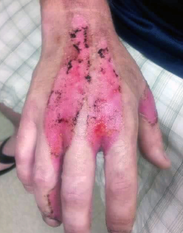 refrigerant burns hand